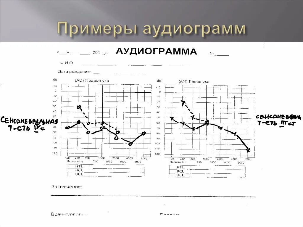 Аудиограмма степени. Крутонисходящая аудиограмма. Аудиограмма пример. Аудиограмма ЛОР. Аудиометрия физиология.