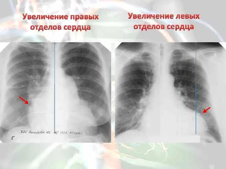 Гипертрофия левого желудочка рентген. Гипертрофия правых отделов сердца рентген. Гипертрофия правого желудочка рентген. Гипертрофия правого желудочка на рентгенограмме. Расширения сердца правой