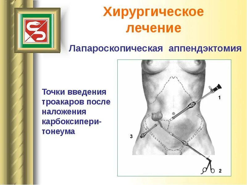 Боли после операции на аппендицит