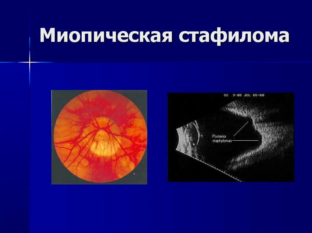 Миопический конус и стафилома. Миопический конус глазное дно. Миопическая стафилома сетчатки. Миопический конус