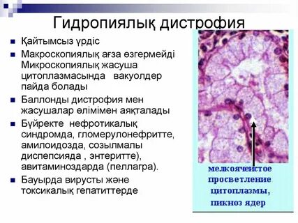 Паренхиматозные дистрофии патанатомия