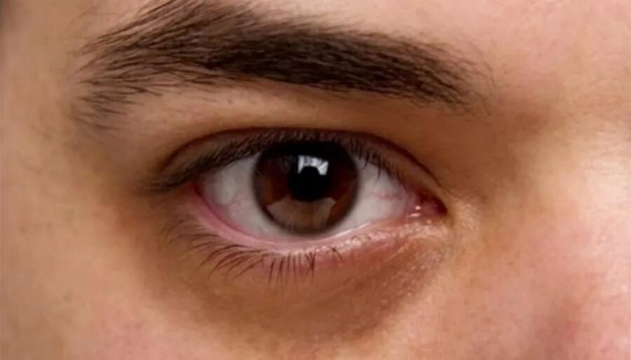Topline results show TearRestore Thermal Mask improves TBUT, symptoms of dry eye