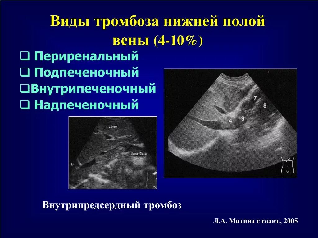 Тромбоз вен печени. Тромбоз нижней полой вены на УЗИ. Тромб нижней полой вены. Тромбоз в нижней полой Вене.