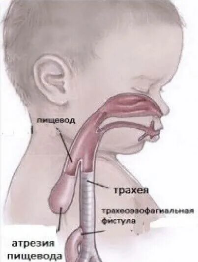 Пищевод новорожденного. Анатомия трахеи и пищевода. Атрезия пищевода у новорожденных.