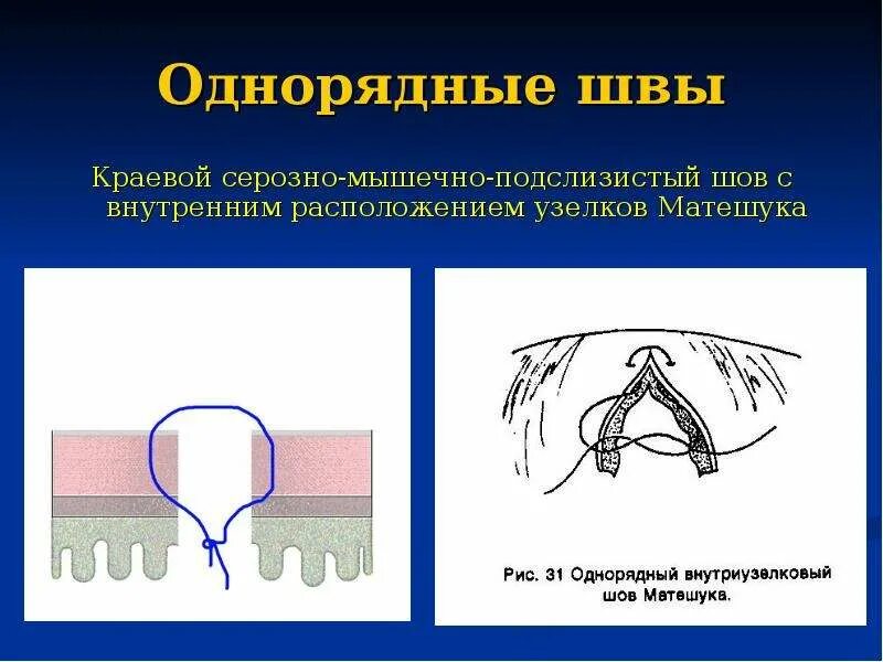 Однорядный серозно-мышечно-подслизистый шов. Однорядный кишечный шов. Однорядный непрерывный шов. Как называется шов после операции