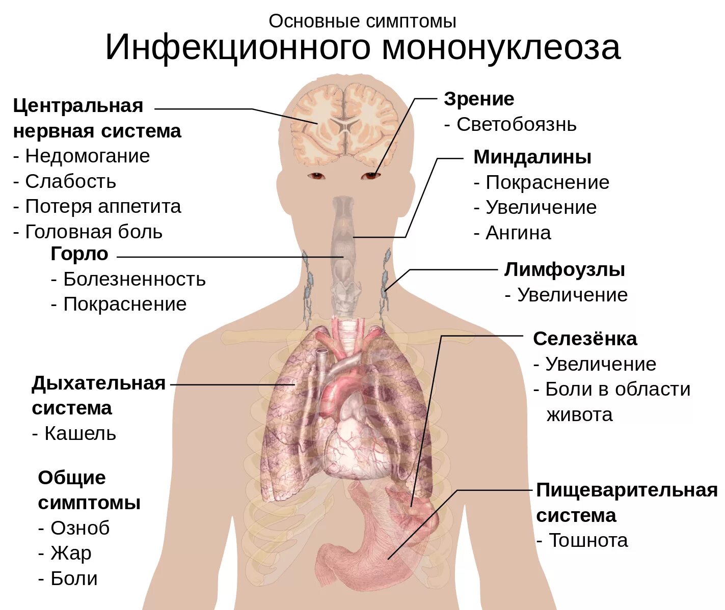 Вирус Эпштейна-Барр симптомы. Поражения внутренних органов при инфекционном мононуклеозе. Мононуклеоз Эпштейна Барра. Инфекционный мононуклеоз (вирус Эпштейна-Барр).