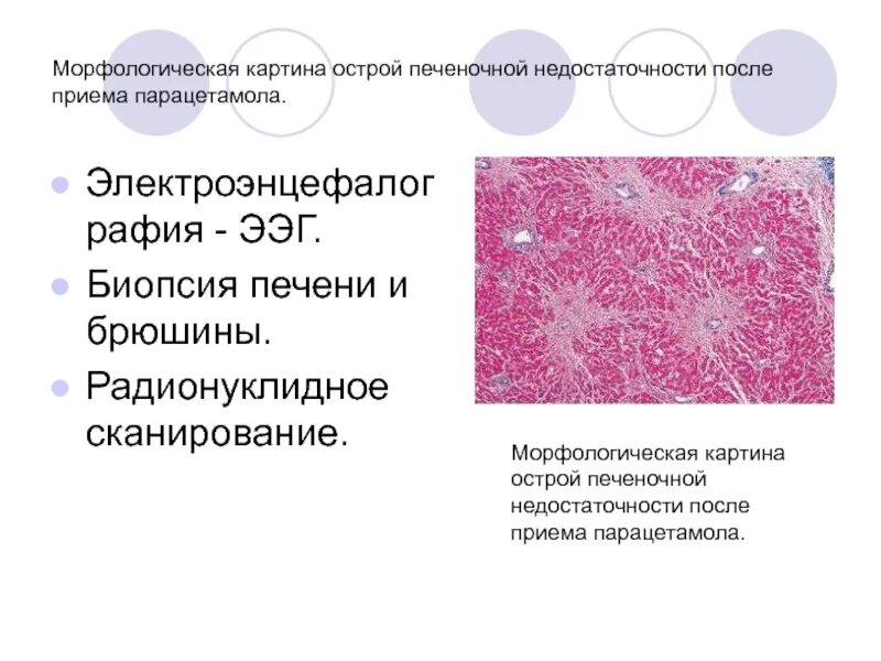 Биопсия печени после биопсии. Морфологическая картина это. Биопсия печени при недостаточности. Морфологическая картина что это такое в медицине.