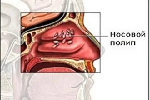 Операция носоглотки