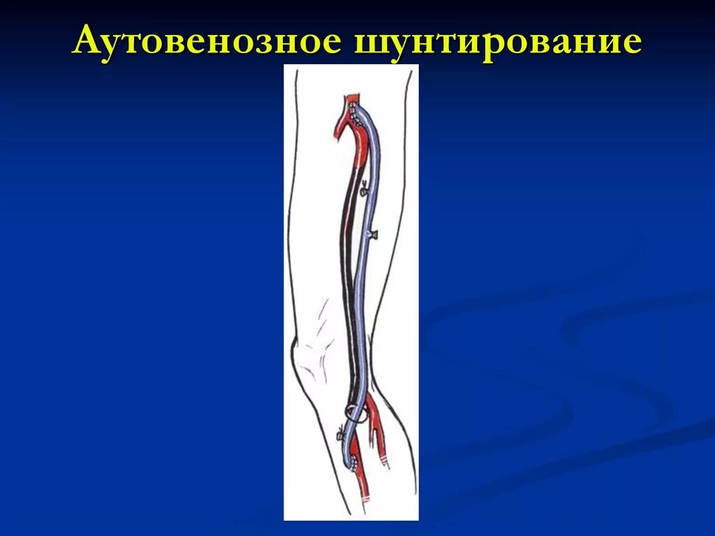 Бедренно-подколенное шунтирование. Аорто подвздошное шунтирование. Аутовенозное шунтирование нижних конечностей. Шунт бедренной артерии. Операция шунтирование нижних