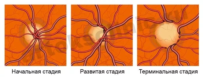 Зрительный нерв при глаукоме. Глаукома диск зрительного нерва. Экскавация зрительного нерва. Экскавация зрительного нерва при глаукоме. Экскавация диска зрительного нерва.