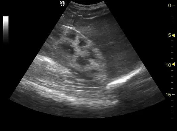 Диффузные изменения синуса обеих почек. Диффузные изменения почек на УЗИ что это. Диффузные изменения эхогенности почек. Паренхима УЗИ. Диффузные изменения паренхимы почек на УЗИ.