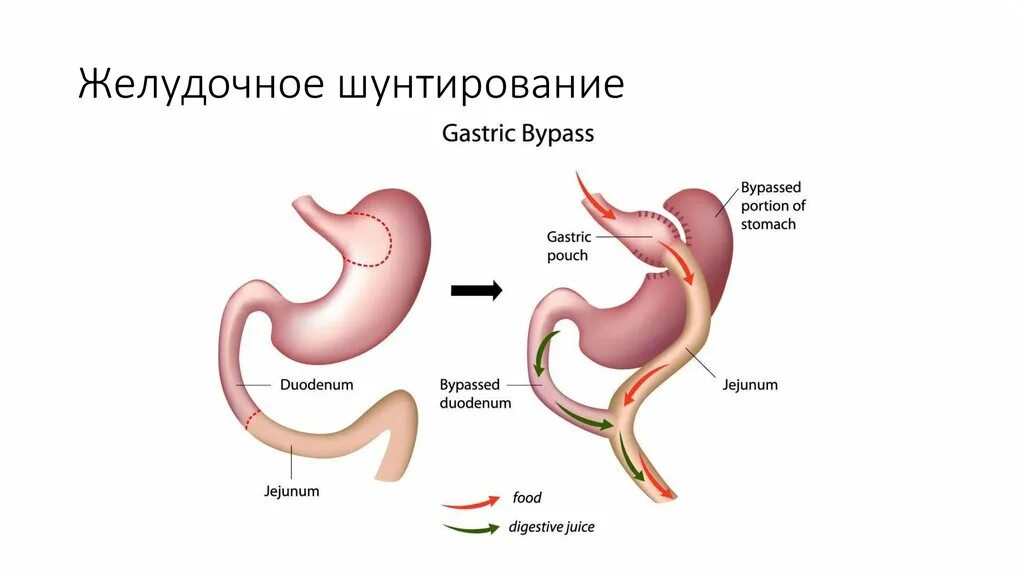Резекция и шунтирование желудка разница. Рукавная гастропластика схема. мини гастрошунтирование операция. лапароскопическое гастрошунтирование. рукавная резекция желудка.