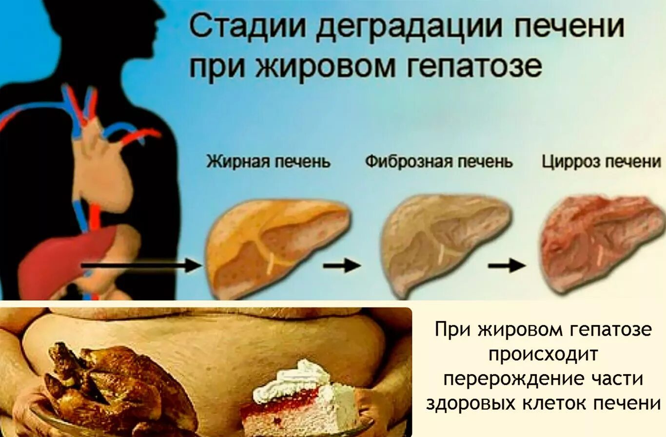 Лечение алкогольного жирового гепатоза