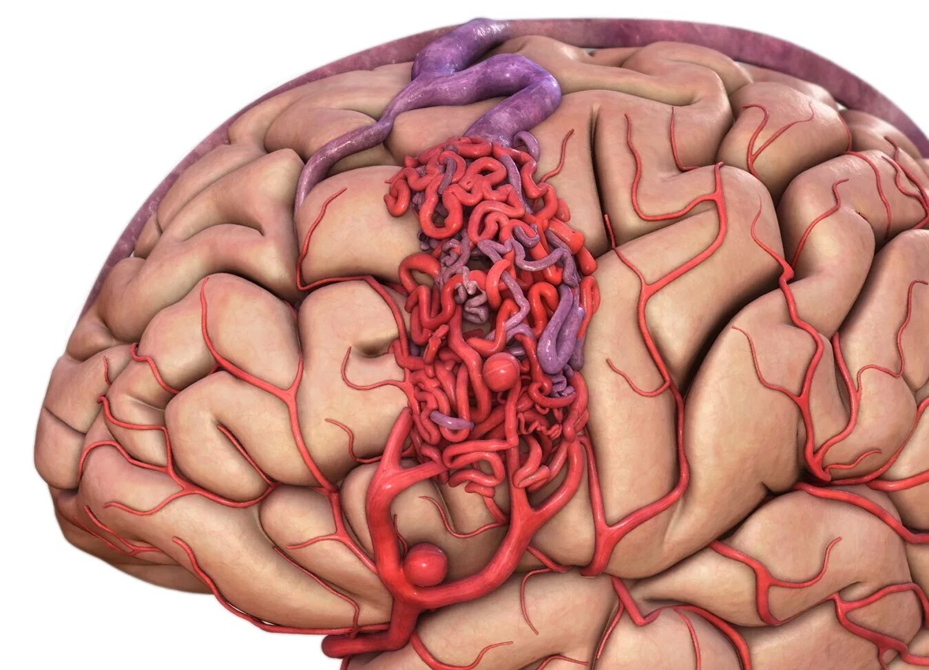 Цереброваскулярный инсульт. АВМ мальформация сосудов головного мозга. Ртерио-венозная мальформация. Артериовенозная мальформация. Артериовенозные мальформации (АВМ) головного мозга..