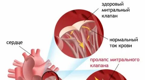 Пролапс задней стенки