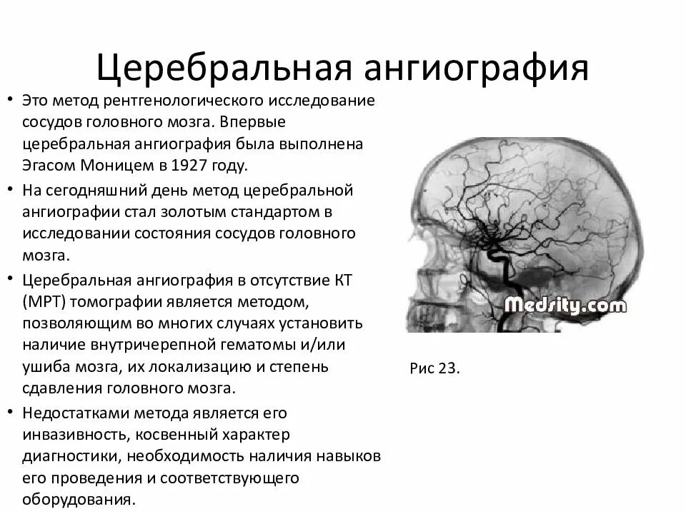 Атрофия мозга лечение. Церебральная ангиография сосудов головного мозга. Церебральная ангиография противопоказания. Церебральные сосуды головного мозга что это. Артериография сосудов головного мозга.