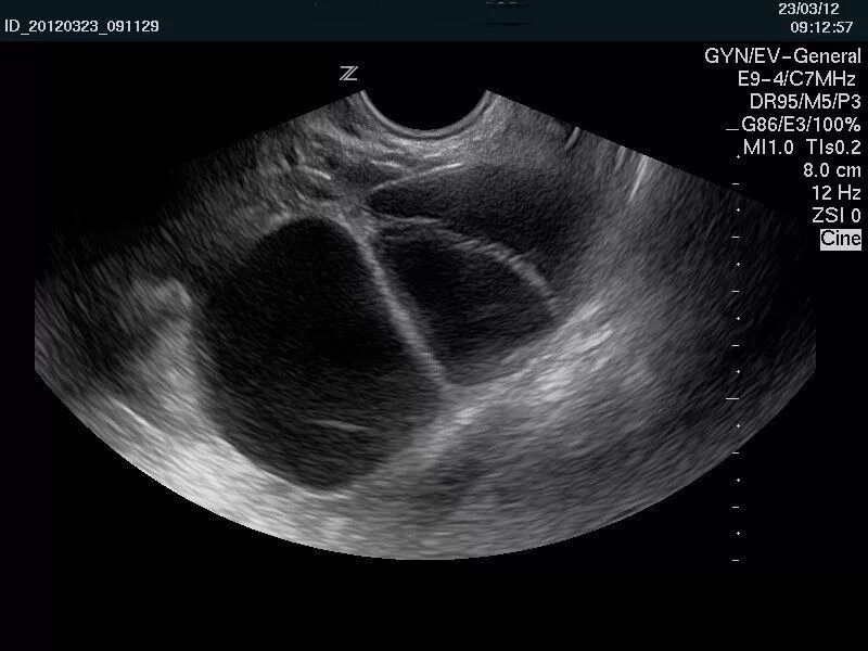 Многокамерная киста яичника на УЗИ. Мультифолликулярные яичники на УЗИ. УЗИ яичников 4 фолликула. Фолликулярная киста яичника на УЗИ. Мфя в гинекологии что
