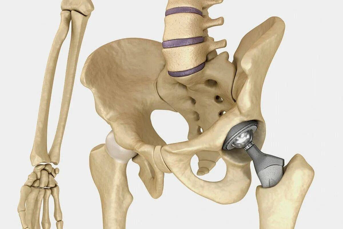Ревизионное эндопротезирование тазобедренного сустава. Коксартроз эндопротезирование тазобедренного сустава. Титановый тазобедренный эндопротез. Эндопротез кости бедра. После эндопротезирования шейки бедра