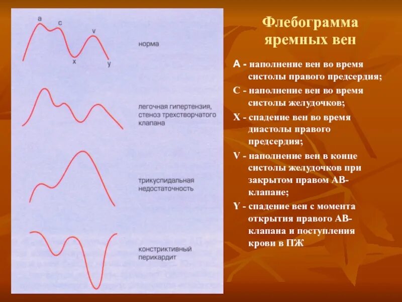 Анализ сфигмограммы и флебограммы. Флебография (венозный пульс).. Анализ Кривой артериального и венозного пульса.. Флебограмма физиология. Норма правого предсердия