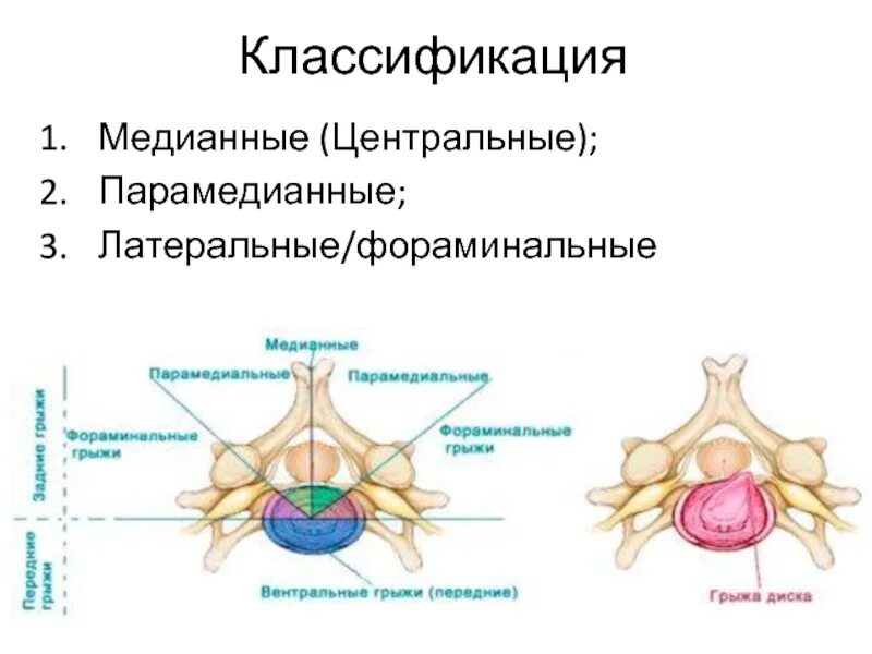 Медианно парамедианная билатеральная. Грыжа диска позвоночника l5 s1. Медианно-парамедианная грыжа. Грыжа позвоночника экструзия. Правосторонняя парамедианная грыжа диска l1.