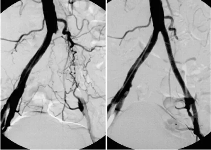 Стентирование подвздошной артерии. Стентирование подвздошной вены. Ангиограмма сосудов нижних конечностей. Тромбоз нижних конечностей ангиография. Стеноз прямой