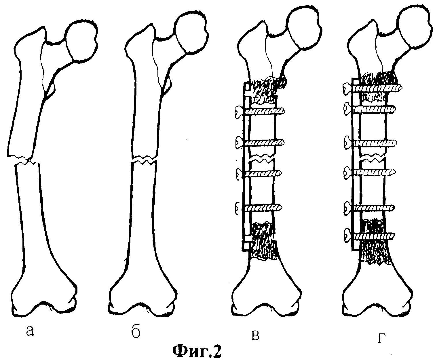 Трещина кости лечение. Остеосинтез перелома бедренной кости. Компрессирующие пластины остеосинтез. Накостный остеосинтез бедренной кости. Экстрамедуллярный остеосинтез.