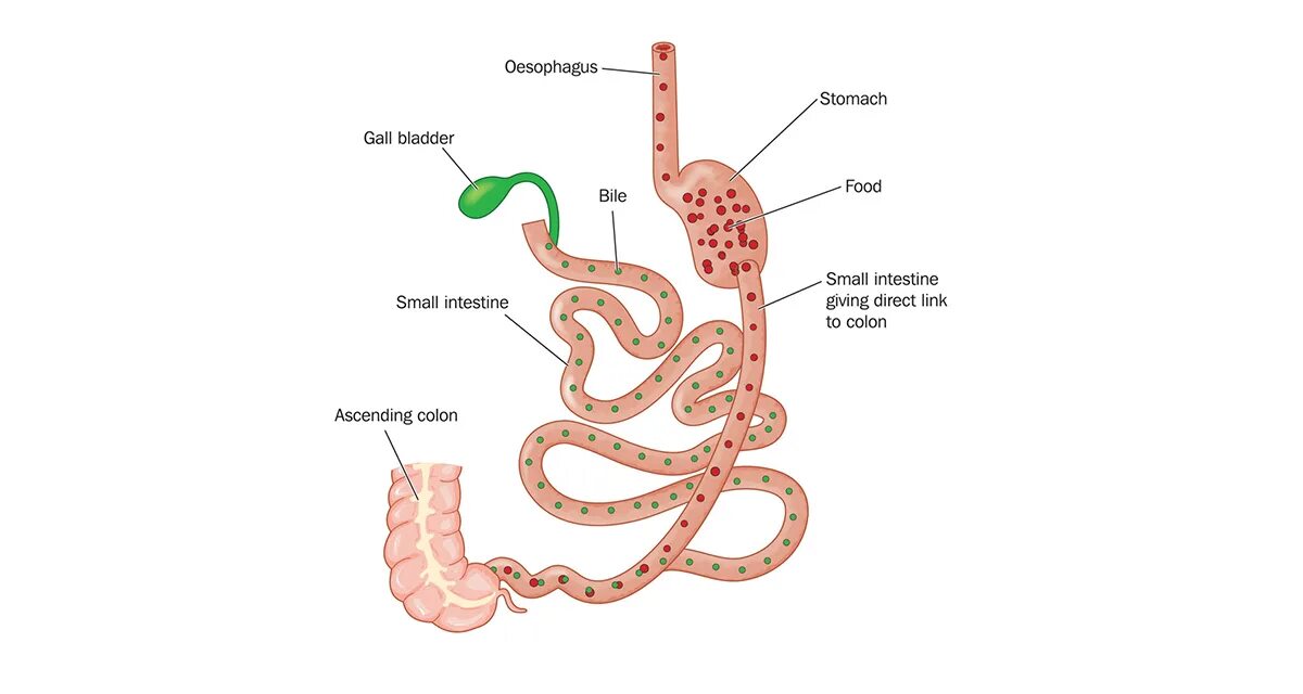 операция по удалению желудка для похудения. операция по удалению желудка для похудения. лапароскопическая продольная «рукавная» резекция желудка. продольная резекция желудка _sleeve gastrectomy. баллонирование желудка операция.