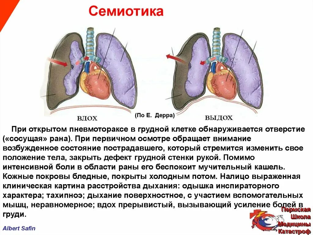 Больно дышать в грудной клетке при вдохе. При открытом пневмотораксе. Боль при выдохе в грудной клетке посередине. Болит в грудине при вдохе. Болит грудная клетка на выдохе.