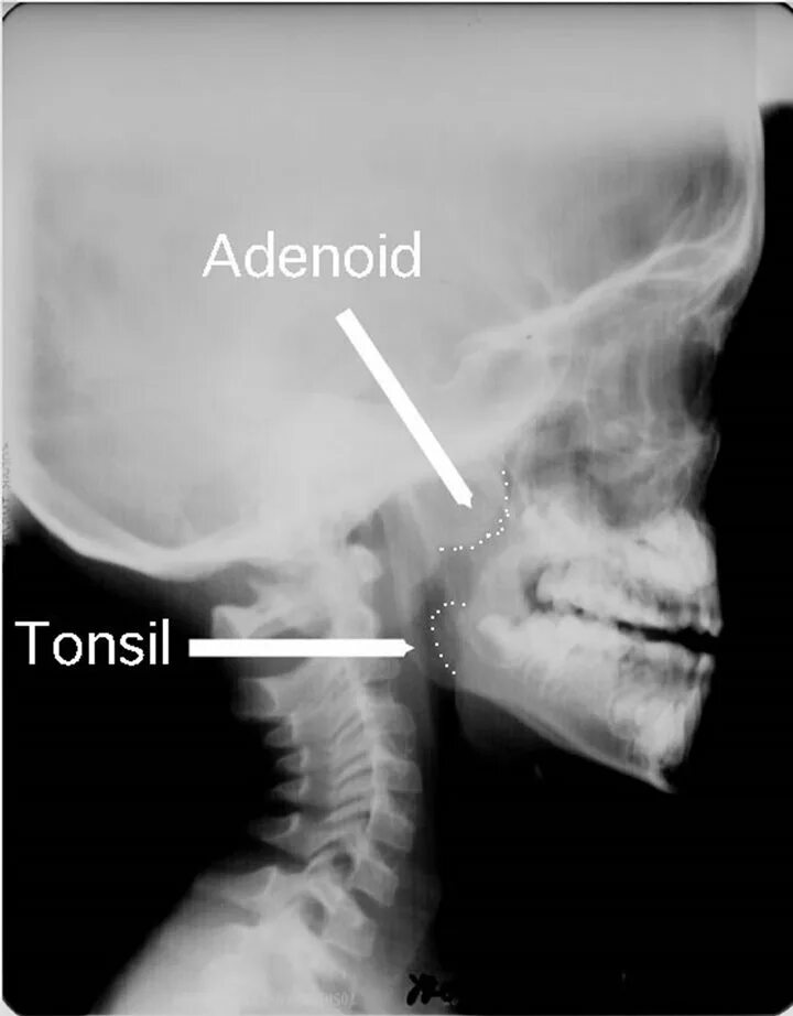 Аденоиды на рентгене