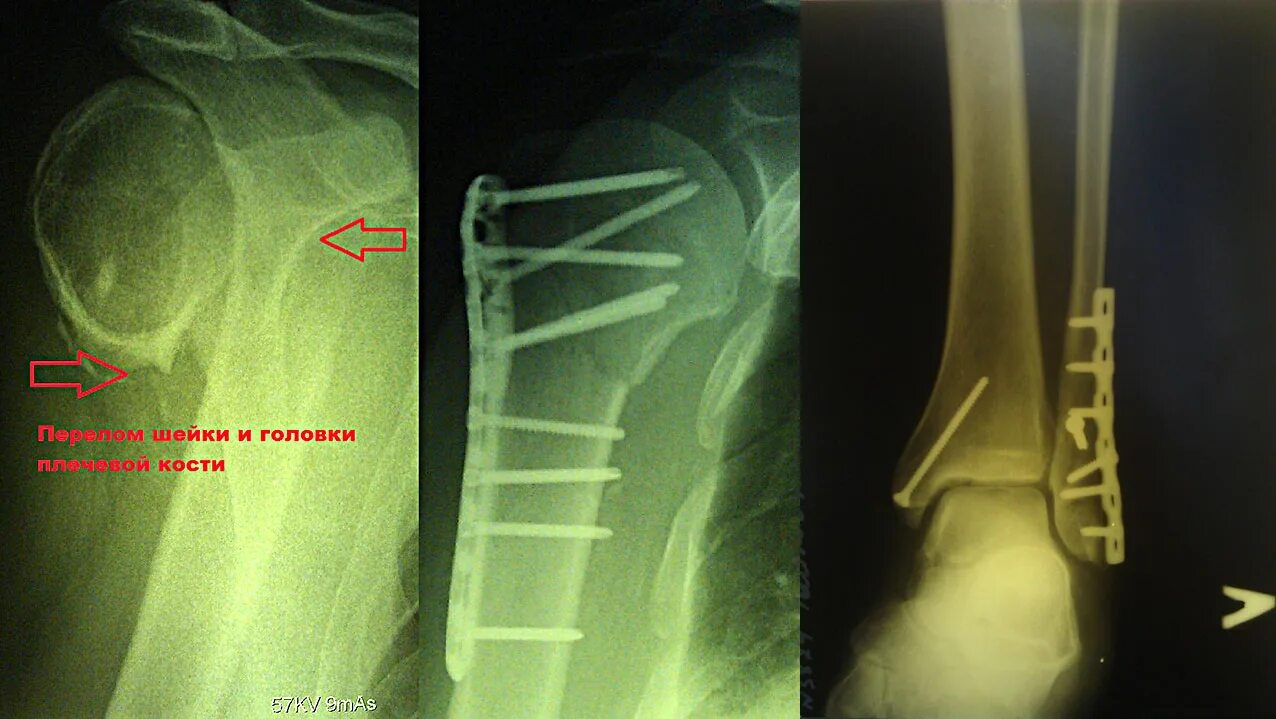 Пластинка остеосинтез плечо перелом. Перелом хирургической шейки плеча остеосинтез. Перелом хирургической шейки плечевой кости рентген остеосинтез. Остеосинтез пластиной перелома хирургической шейки плечевой кости. Перелом плеча пластина