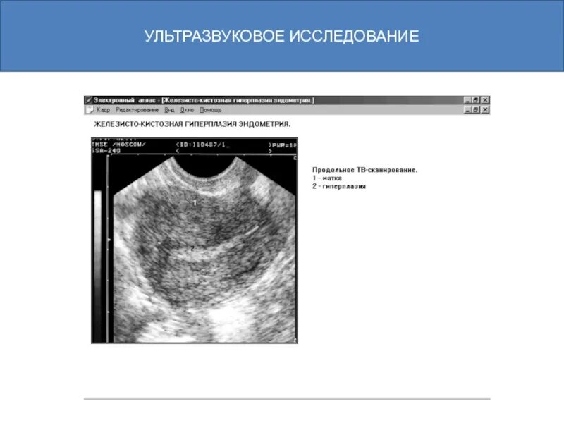 Полип эндометрия УЗИ протокол. Стромальная гиперплазия эндометрия УЗИ. Гиперплазия эндометрия УЗИ протокол. Железисто-кистозная гиперплазия эндометрия УЗИ протокол. Рак матки на узи виден