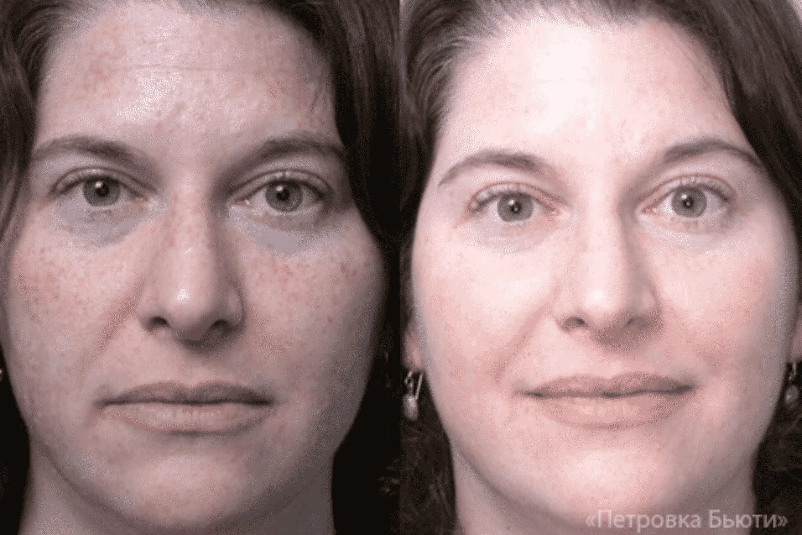 Эффект после лечения. Химический пилинг гликолевой кислотой. Химический пилинг до и после. Химический пилинг лица фото до и после.