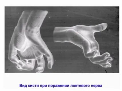 Зудека после перелома