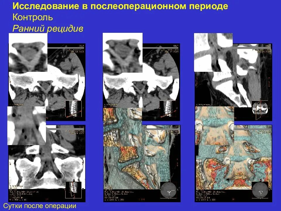 Рак рецидив после операции. Рецидив после операции. исследование после операции. рецидив грыжи после операции.