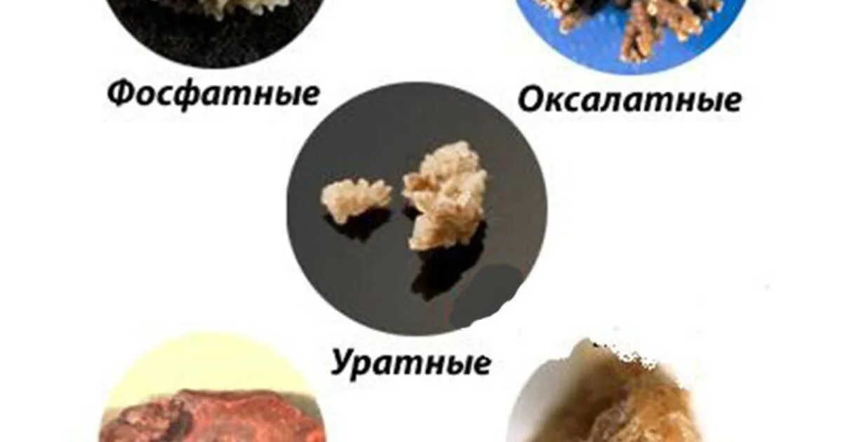Песок выходит из почек симптомы у женщин