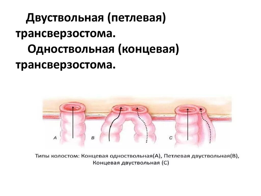 Типы стом. Петлевая трансверзостомия. двухствольгая колостома. трансверзостомия колостомия. формирование двуствольной колостомы.