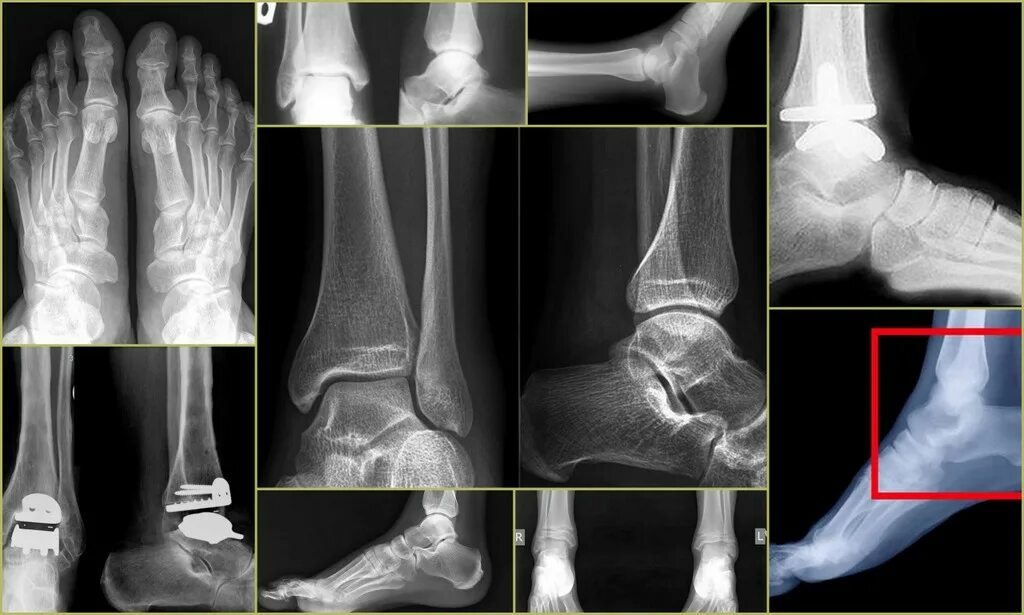Кости стопы снимок рентген. Остеоартроз голеностопного сустава рентген. Рентген голеностопного сустава в прямой проекции. Перелом наружной лодыжки рентген.