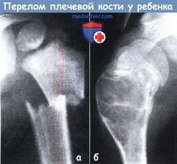 Переломы плечевой кости у детей