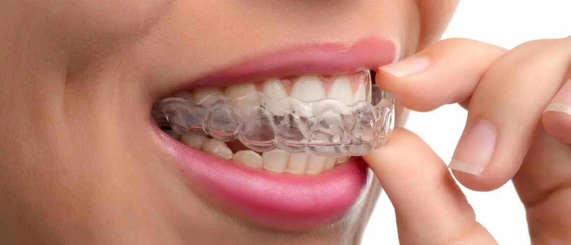 Капы для исправления прикуса. Каппы Инвизилайн Invisalign.