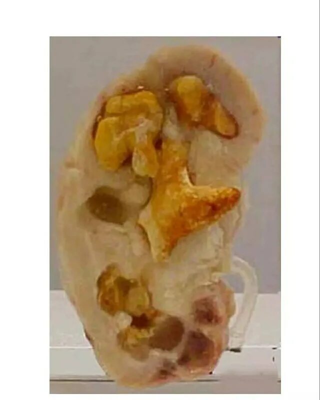 камни в почках форум