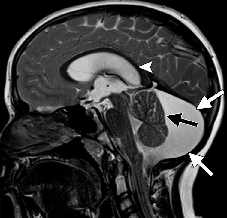 Ретроцеребеллярная цистерна киста. Ретроцебеллярная киста. Ретроцеребеллярная ликворная киста кт. Ретроцеребеллярная ликворная киста мкб 10. Арахноидальные изменения ликворокистозного характера