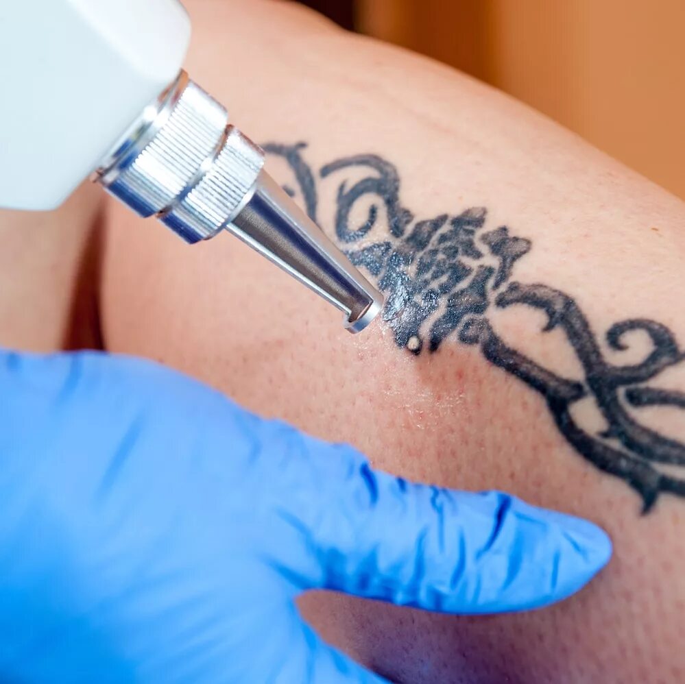 Лазерное удаление тату. Перманентный макияж лазерная эпиляция. Ivabori tattoo. Сведение тату лазером процесс. Машинка по удалению татуировок.