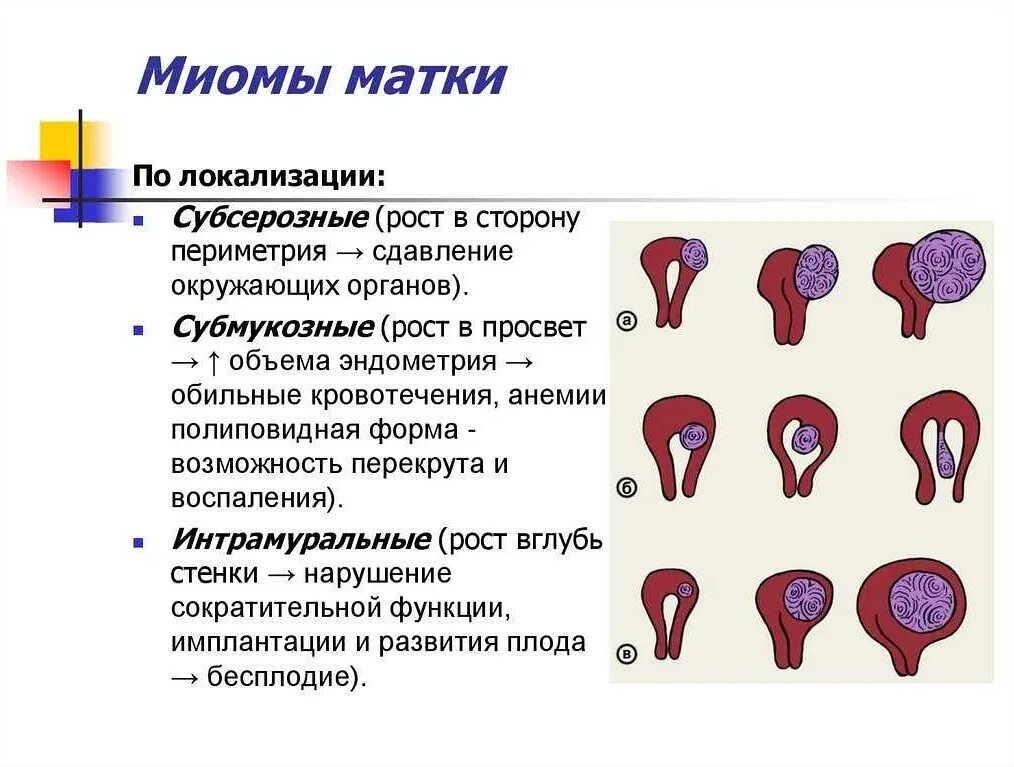 Плотный проведение. Узловая миома матки 33мм. Типы субсерозной миомы матки. Типы роста миоматозных узлов.. Миома шеечной локализации.