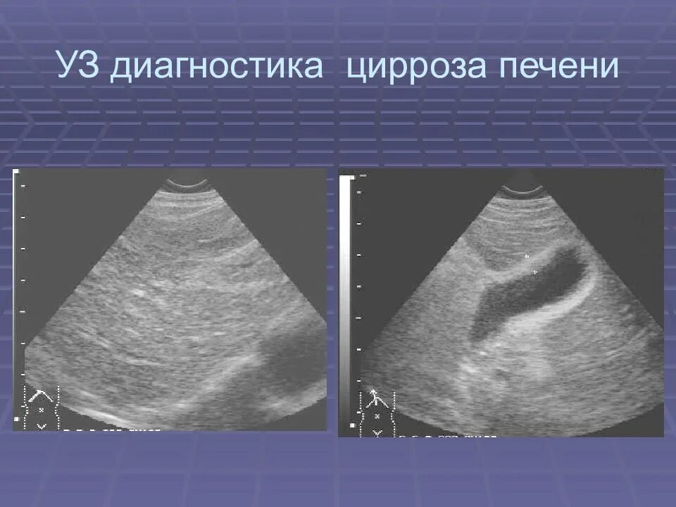 Узи признаки цирроза. Узи картина цирроза печени крупноузловой. Узи признаки цирроза. Узи печени при циррозе описание. Узи признаки цирроза.