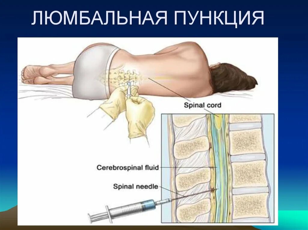 Сколько делают пункцию. Люмбальная пункция и спинномозговая пункция. Люмбальная спинномозговая пункция. Люмбальная пункция уровни пункции. Поясничный прокол люмбальная пункция.