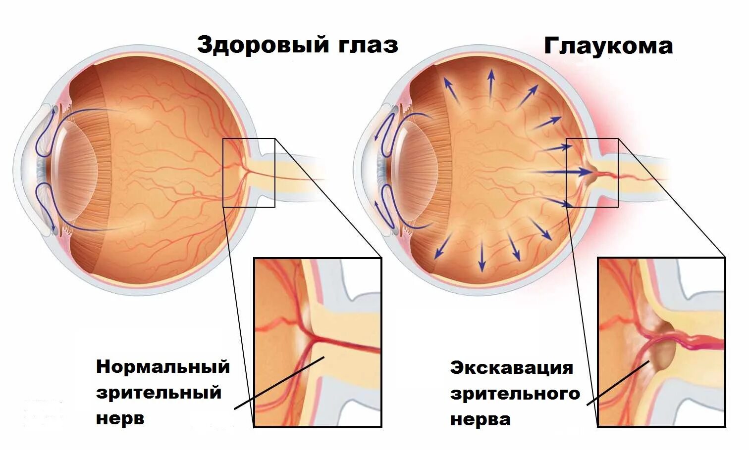 Повышение внутриглазного давления симптомы