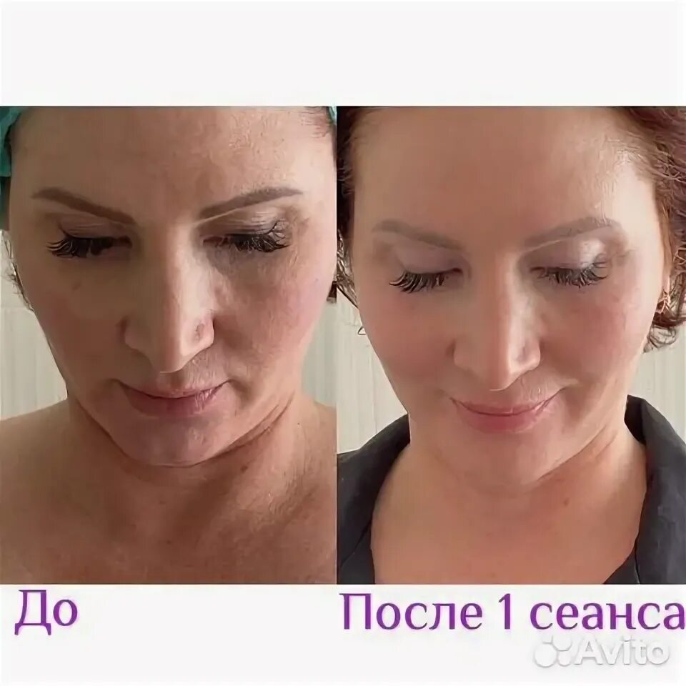 Индиба глаз. Индиба фото до и после. Безоперационная подтяжка лица. Индиба фото до и после. Indiba терапия.
