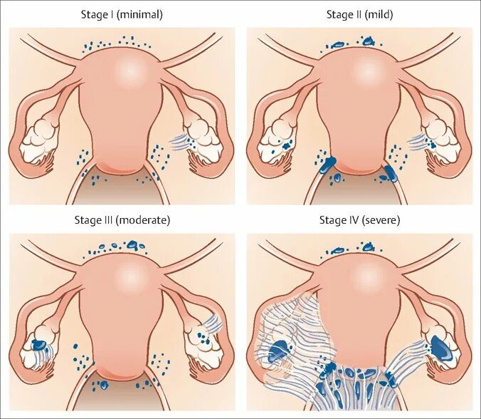 Эндометриоидные кисты яичников стадии. Стадии внутреннего эндометриоза.