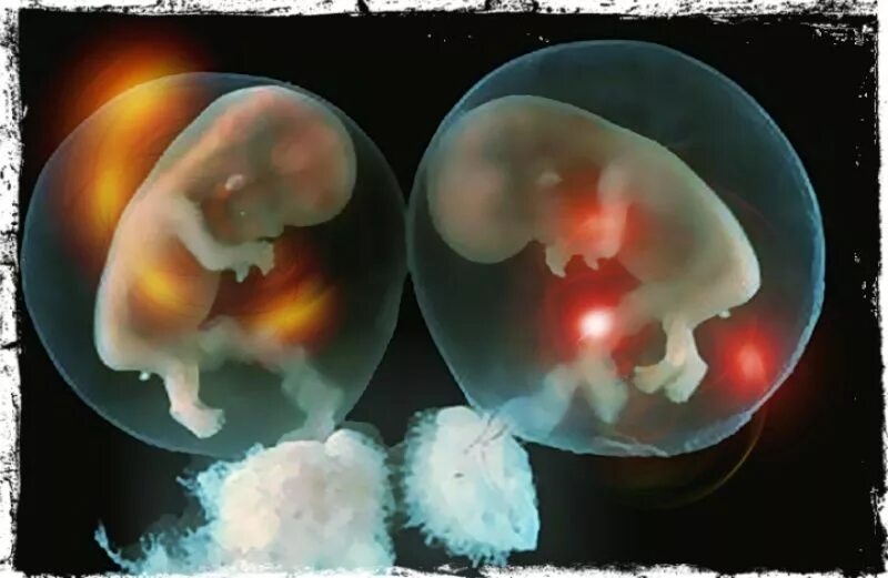 Двойня 20 неделя. Многоплодная беременность беременность двойней. Эмбрион многоплодная беременность. Дизиготная многоплодная беременность. Многоплодная беременность в утробе.