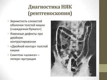 Диагностика толстой кишки